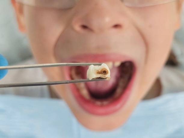 Best Emergency Wisdom Tooth Extraction in Lakeview, CA