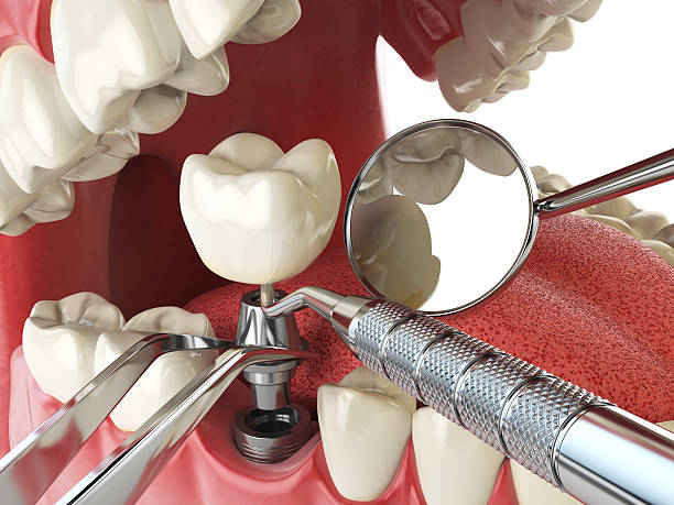 Best Emergency Denture Repair in Lakeview, CA